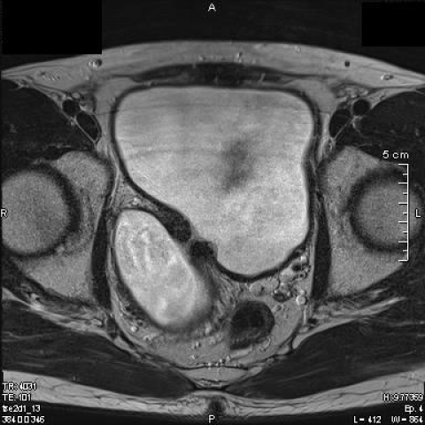 дивертикул мочевого пузыря на МРТ