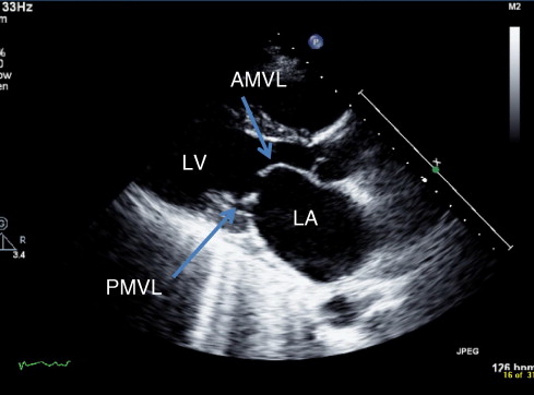 митральный стеноз на УЗИ