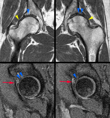  импиджмент-синдром тазобедренного сустава на МРТ