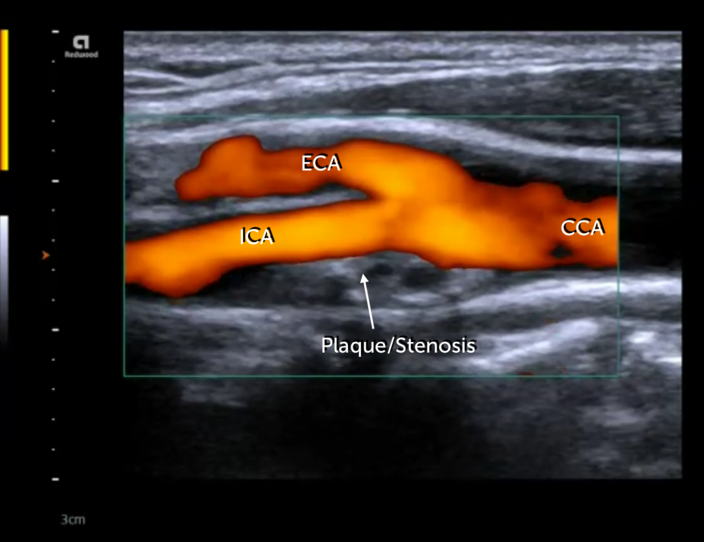 стеноз артерий на УЗИ