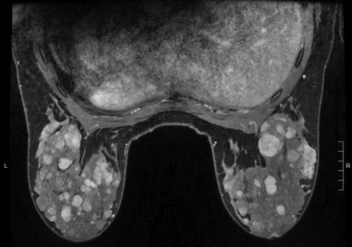 фиброаденома молочной железы на МРТ