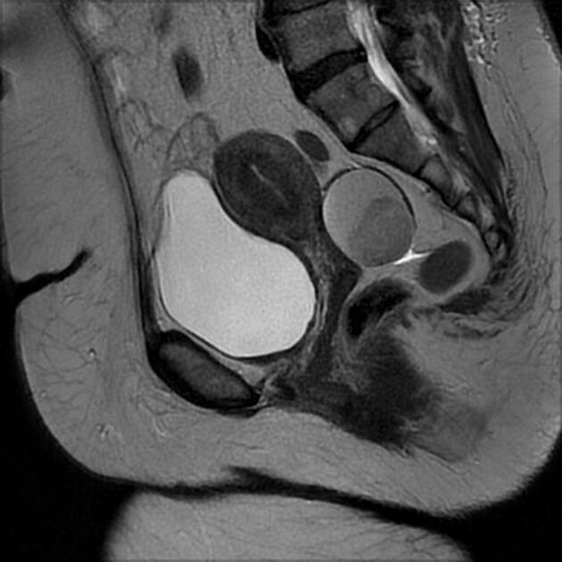 эндометриоидная киста яичника на МРТ