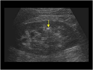 мочекаменная болезнь на УЗИ