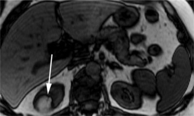 ангиолипома почки на МРТ снимках