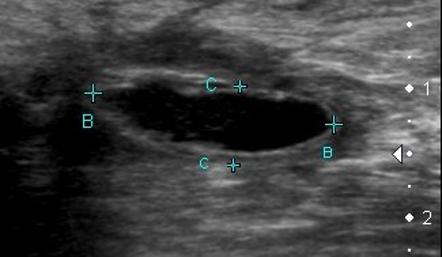 серома на УЗИ