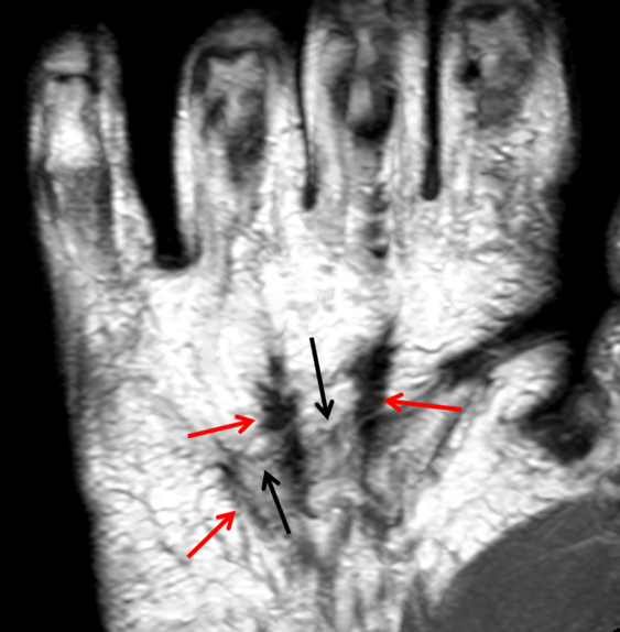 контрактура Дюпюитрена на МРТ