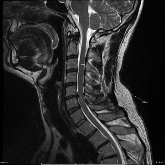 стеноз шейного отдела позвоночника на МРТ
