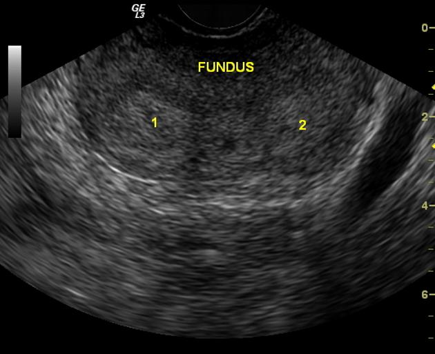 двурогая матка на УЗИ