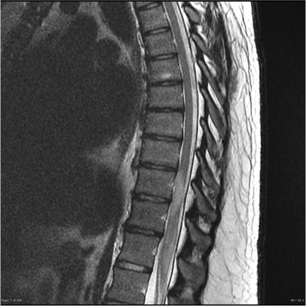 поперечный миелит на МРТ