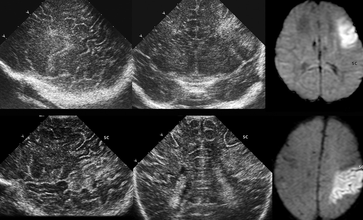 Инсульт головного мозга на УЗИ снимке