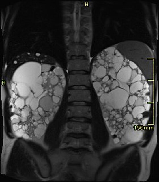 поликистозная болезнь почек на МРТ
