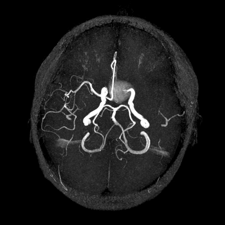 аневризма мозга на МРТ снимках