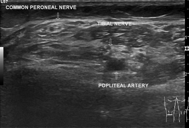 невропатия большеберцового нерва на УЗИ