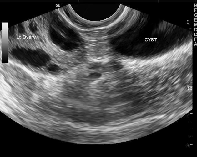 параовариальная киста яичника на УЗИ