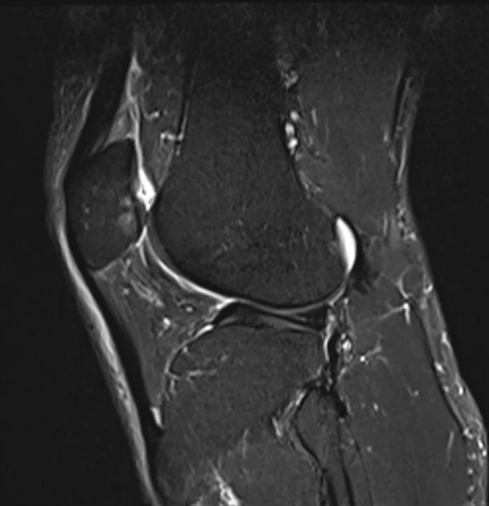хондромаляция надколенника на МРТ
