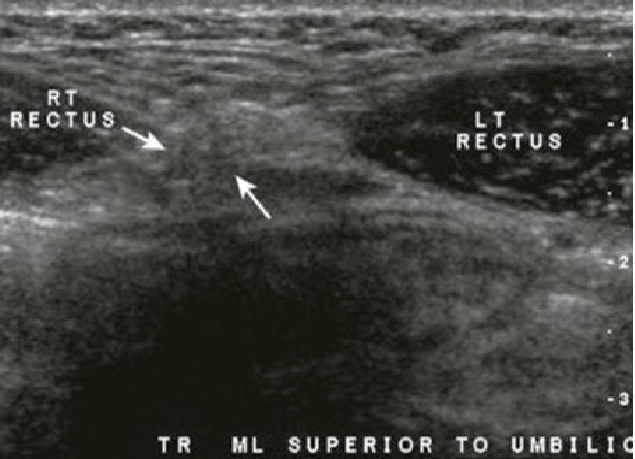 грыжа белой линии живота на УЗИ