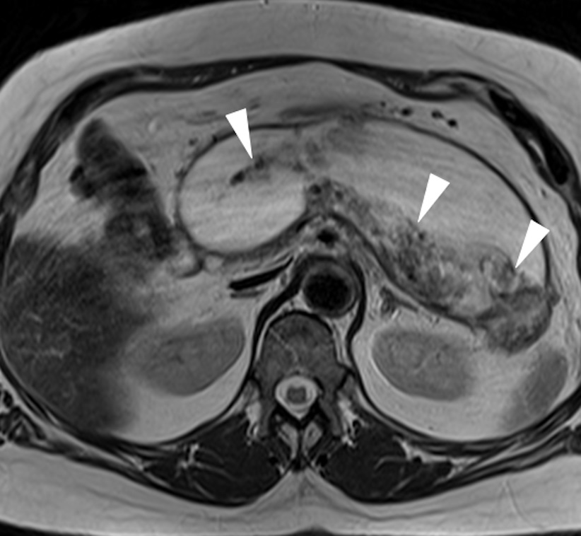 панкреонекроз на МРТ