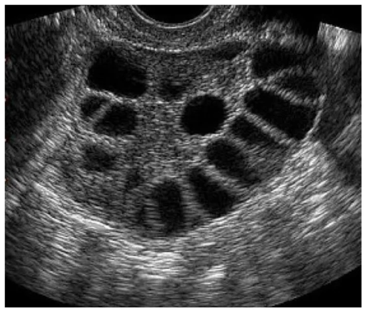поликистоз яичников на УЗИ