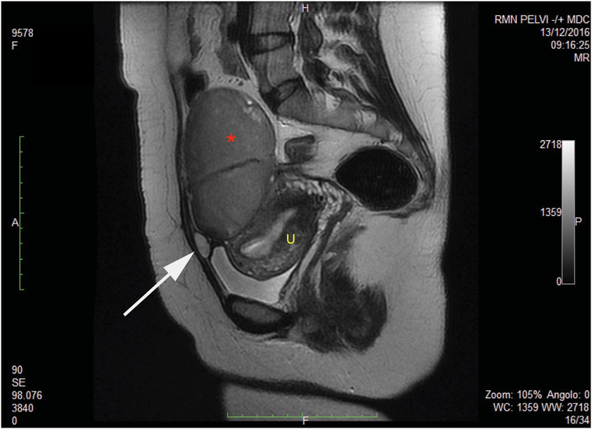 киста урахуса на сканах МРТ снимках