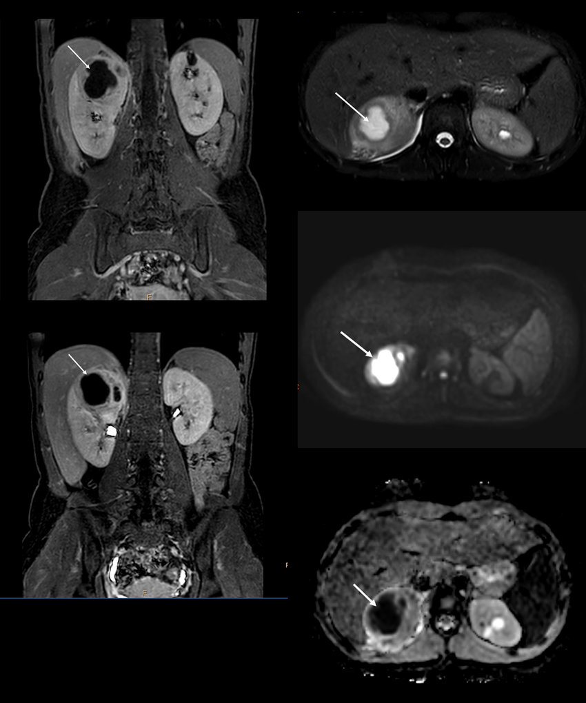 абсцесс почек на МРТ снимках