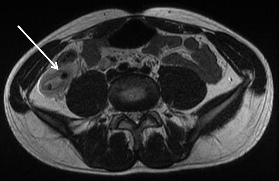  аппендицит на МРТ снимке