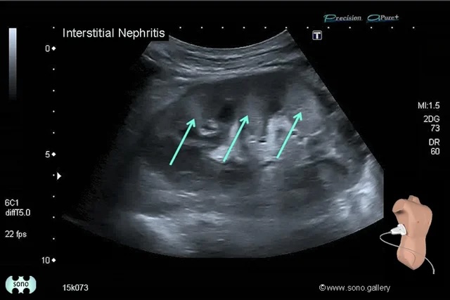 интерстициальный нефрит на УЗИ снимках