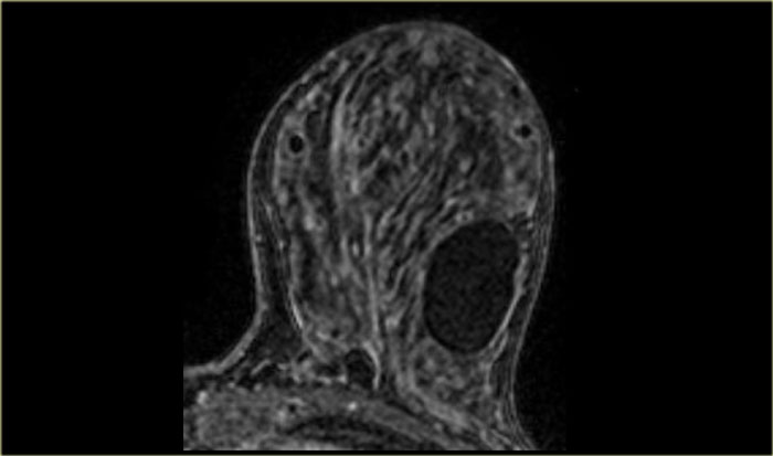 киста молочной железы на МРТ