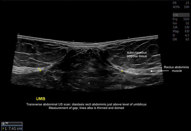  диастаз прямых мышц живота на УЗИ