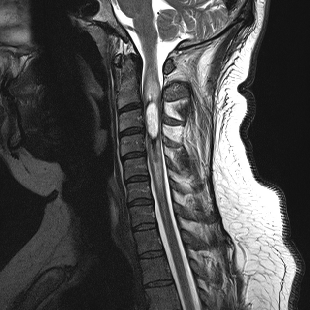 опухоль позвоночника на МРТ