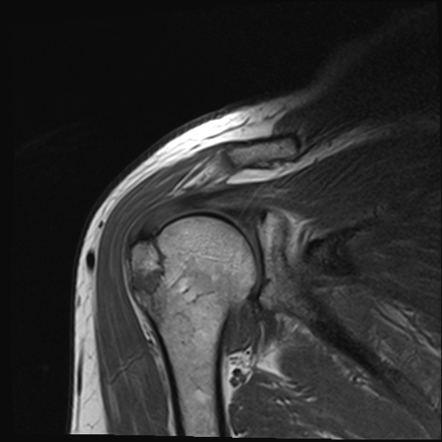 перелом большого бугорка плечевой кости на МРТ
