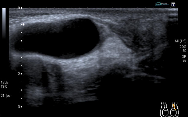 киста семенного канатика на УЗИ