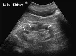 нефросклероз на УЗИ