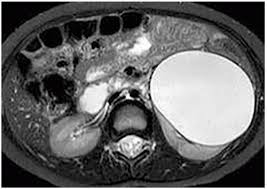 киста почки на МРТ