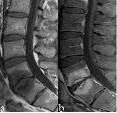 поясничный остеохондроз на МРТ