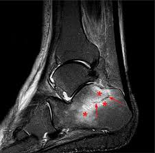 перелом лодыжки на МРТ