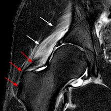 тендинопатия на МРТ