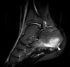 перелом пяточной кости на МРТ