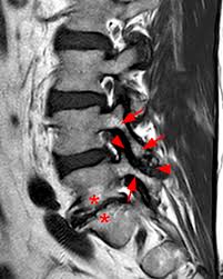 фасеточный синдром на МРТ