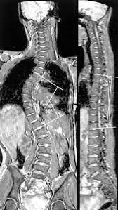 Искривление позвоночника на МРТ снимках
