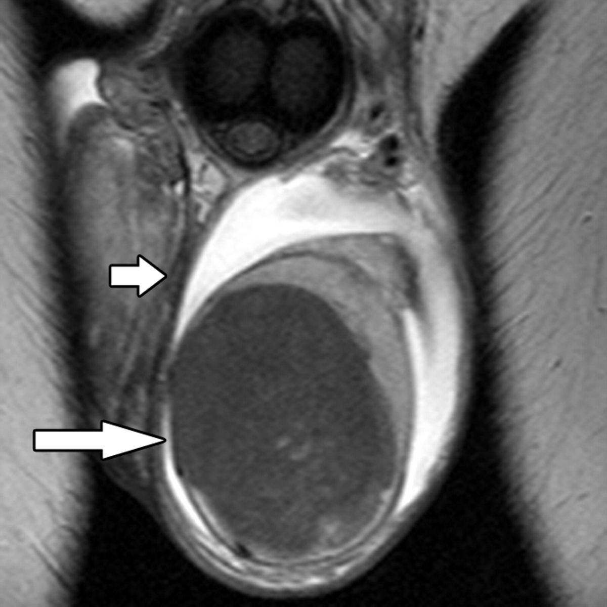 опухоль яичка на МРТ