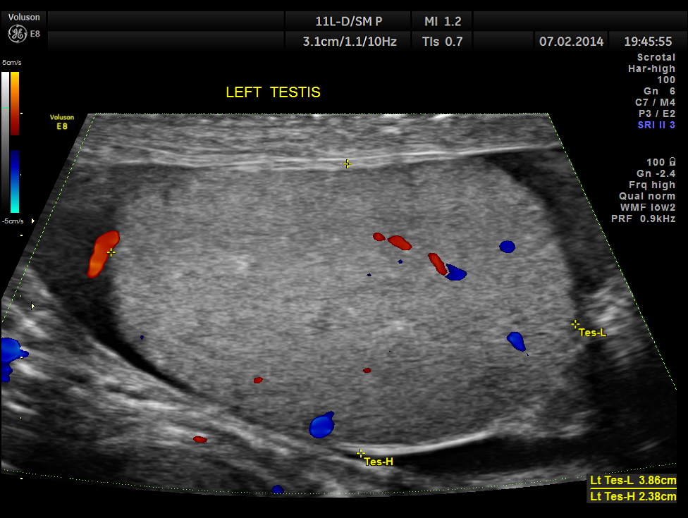 варикоцеле на УЗИ